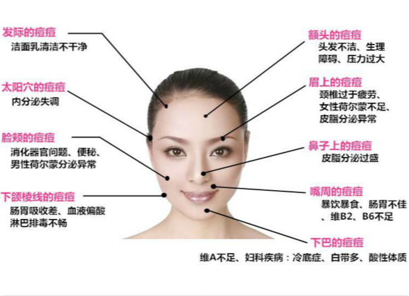 原來(lái)這些因素會(huì)導(dǎo)致長(zhǎng)痘痘!你知道嗎? 原來(lái)這些因素會(huì)導(dǎo)致長(zhǎng)痘痘!你知道嗎?