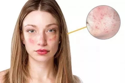 春季過敏不止你一個(gè) 預(yù)防要專業(yè)! 春季過敏不止你一個(gè) 預(yù)防要專業(yè)!