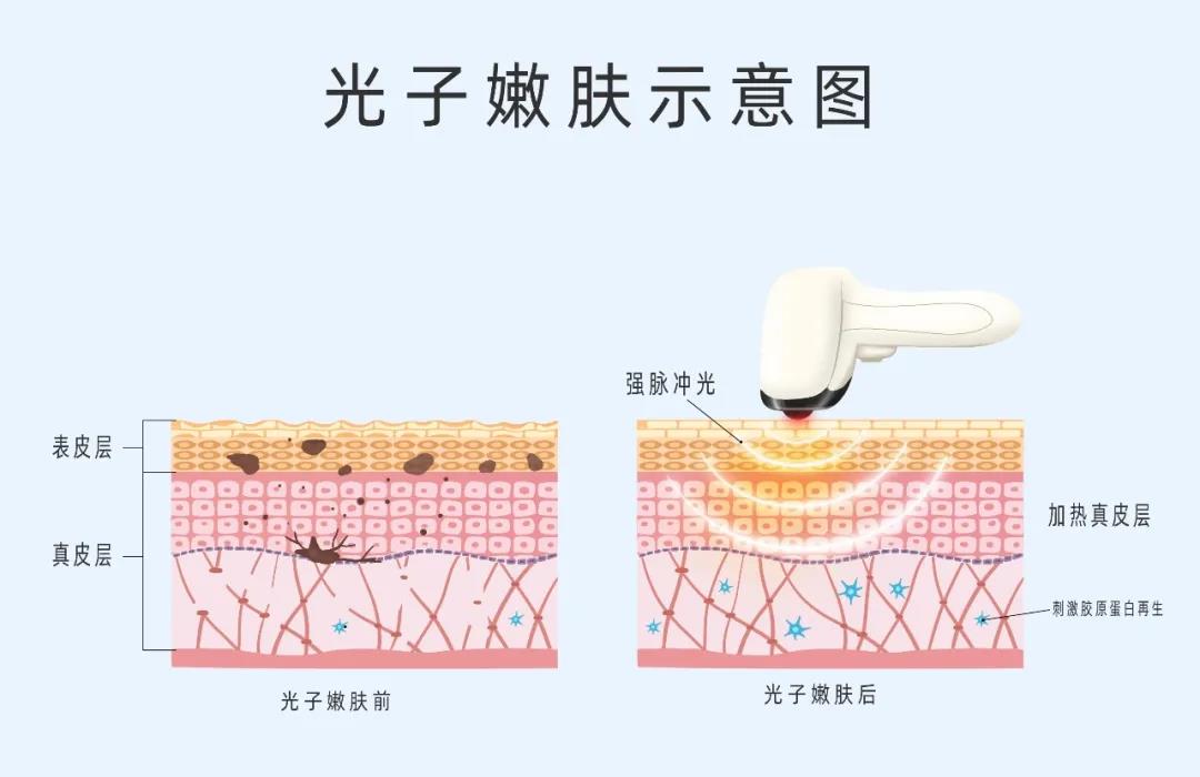 做好術(shù)后修復(fù),拒絕“無效醫(yī)美” 做好術(shù)后修復(fù),拒絕“無效醫(yī)美”